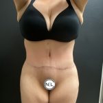 Abdominoplasty Before & After Patient #15781