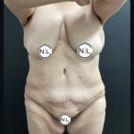 Abdominoplasty Before & After Patient #15781