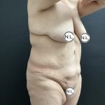 Abdominoplasty Before & After Patient #15781