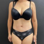 Abdominoplasty Before & After Patient #15791