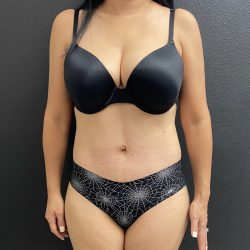 Abdominoplasty Before & After Patient #15791