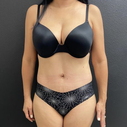 Liposuction Before & After Patient #15791