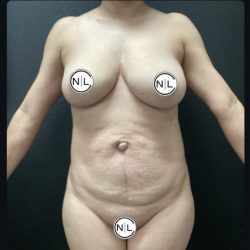 Abdominoplasty Before & After Patient #15791