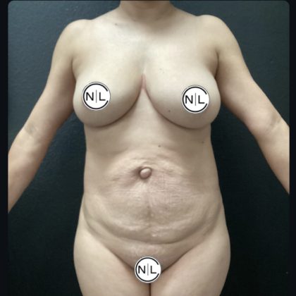 Liposuction Before & After Patient #15791