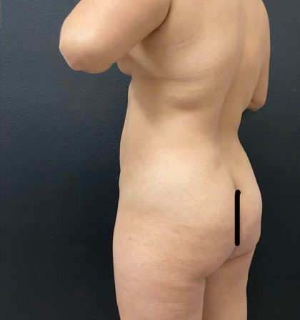 Brazilian Butt Lift Before & After Patient #15816