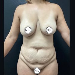 Mommy Makeover Before & After Patient #15833