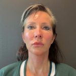 Jawline/Neck Before & After Patient #15806