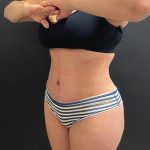 Abdominoplasty Before & After Patient #15819