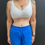 Weight Loss Before & After Patient #15829