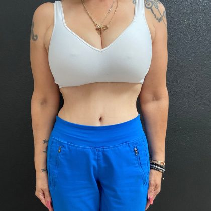 Weight Loss Before & After Patient #15829