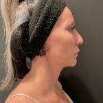 Jawline/Neck Before & After Patient #15806