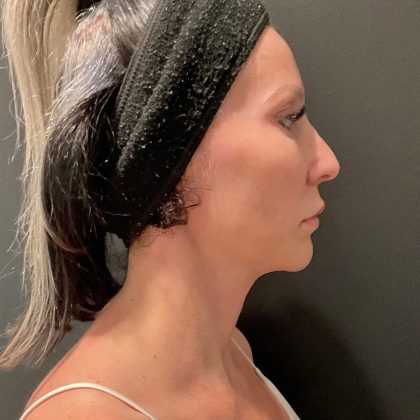 Jawline/Neck Before & After Patient #15806