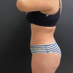 Abdominoplasty Before & After Patient #15819