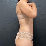 Abdominoplasty Before & After Patient #15825