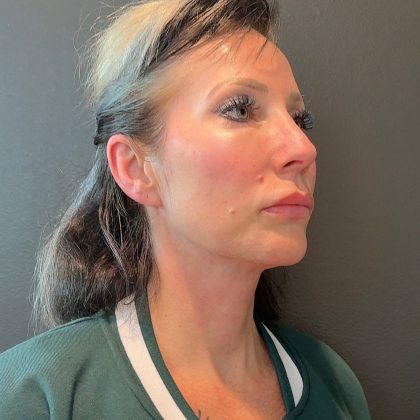 Jawline/Neck Before & After Patient #15806