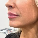 Lip Injections Before & After Patient #15796