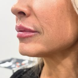 Lip Injections Before & After Patient #15796