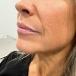 Lip Injections Before & After Patient #15796
