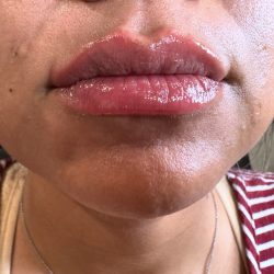 Lip Injections Before & After Patient #15801
