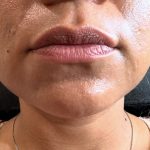 Lip Injections Before & After Patient #15801