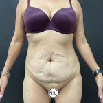 Abdominoplasty Before & After Patient #15853