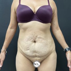 Abdominoplasty Before & After Patient #15853