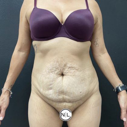 Abdominoplasty Before & After Patient #15853