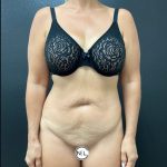 Abdominoplasty Before & After Patient #15883