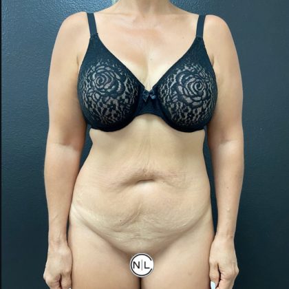 Abdominoplasty Before & After Patient #15883