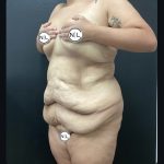 Abdominoplasty Before & After Patient #15884