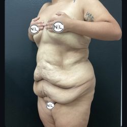 Abdominoplasty Before & After Patient #15884