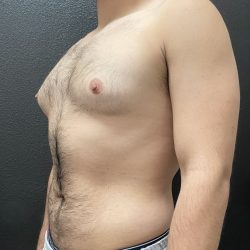 Gynecomastia Before & After Patient #15855