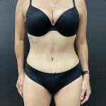 Abdominoplasty Before & After Patient #15853