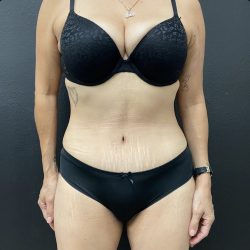Abdominoplasty Before & After Patient #15853
