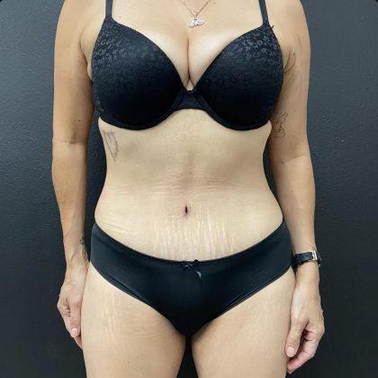 Abdominoplasty Before & After Patient #15853