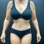Abdominoplasty Before & After Patient #15883