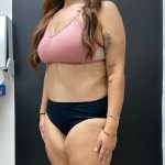 Abdominoplasty Before & After Patient #15884