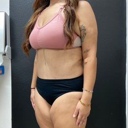 Abdominoplasty Before & After Patient #15884