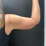 Brachioplasty Before & After Patient #15885