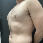 Gynecomastia Before & After Patient #15855