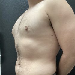 Gynecomastia Before & After Patient #15855