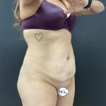 Abdominoplasty Before & After Patient #15853