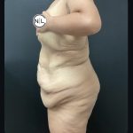 Abdominoplasty Before & After Patient #15884