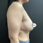 Breast Reduction Before & After Patient #15857
