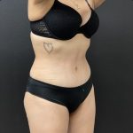 Abdominoplasty Before & After Patient #15853