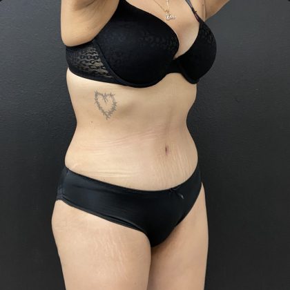 Abdominoplasty Before & After Patient #15853