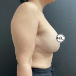 Breast Reduction Before & After Patient #15857