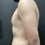 Gynecomastia Before & After Patient #15855