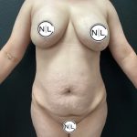 Abdominoplasty Before & After Patient #15900
