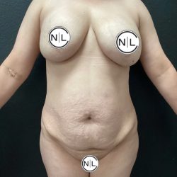 Abdominoplasty Before & After Patient #15900